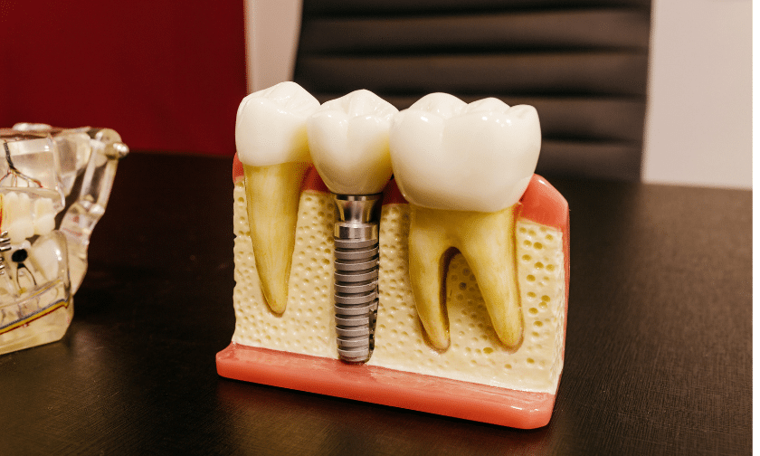 Dental Implants Dentist