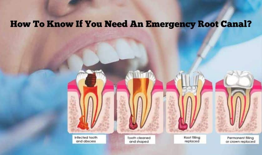 root canal treatment in Round Rock