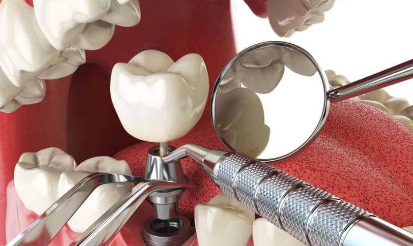 Dental Implant