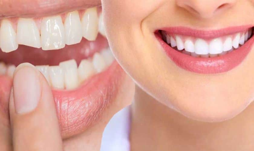 Reasons for Bonding & Veneers Before Teeth Whitening
