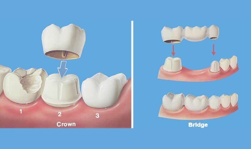 Dental Crown VS Dental Bridge