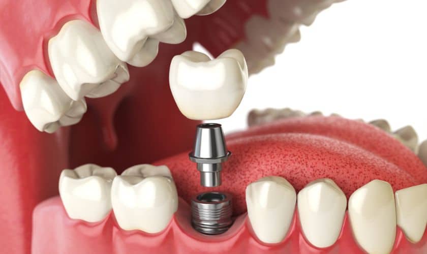 Dental Implants