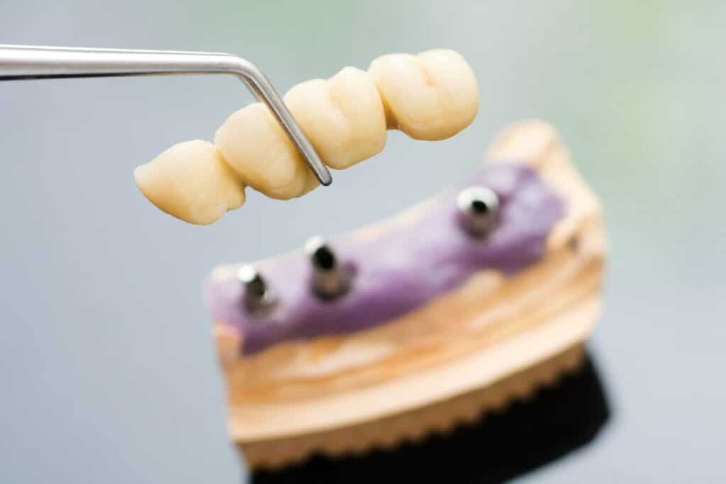 Dental Bridges In Round Rock TX