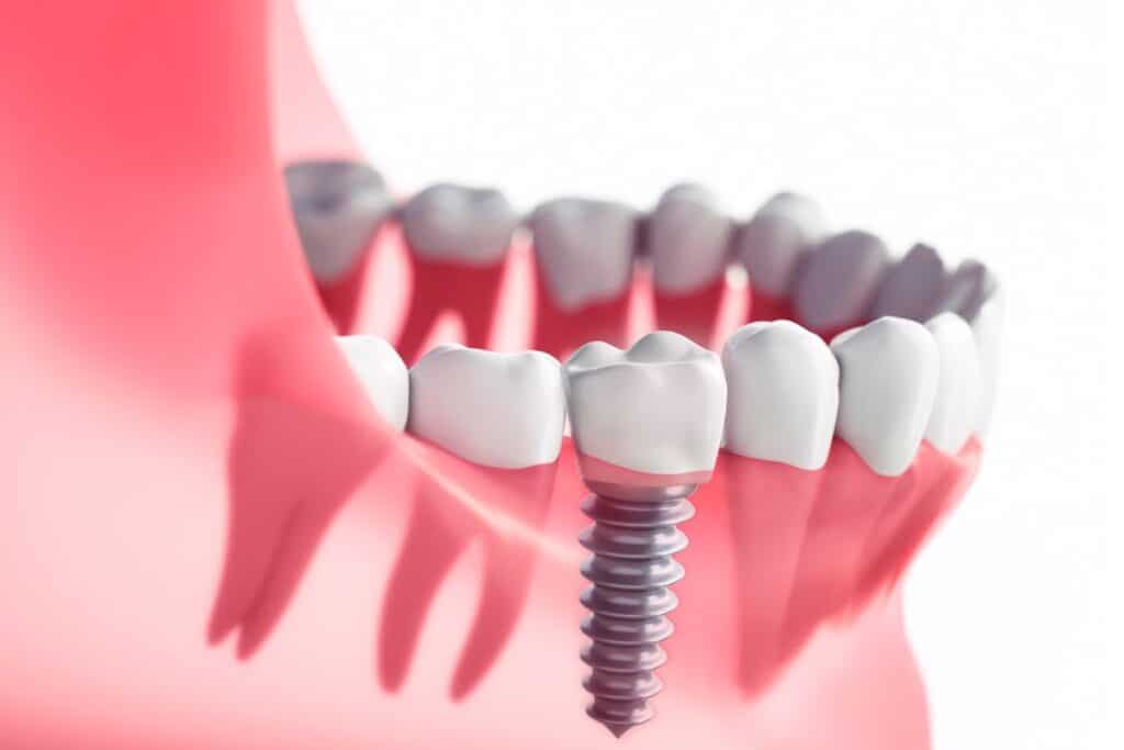 Dental Implants in Round Rock TX