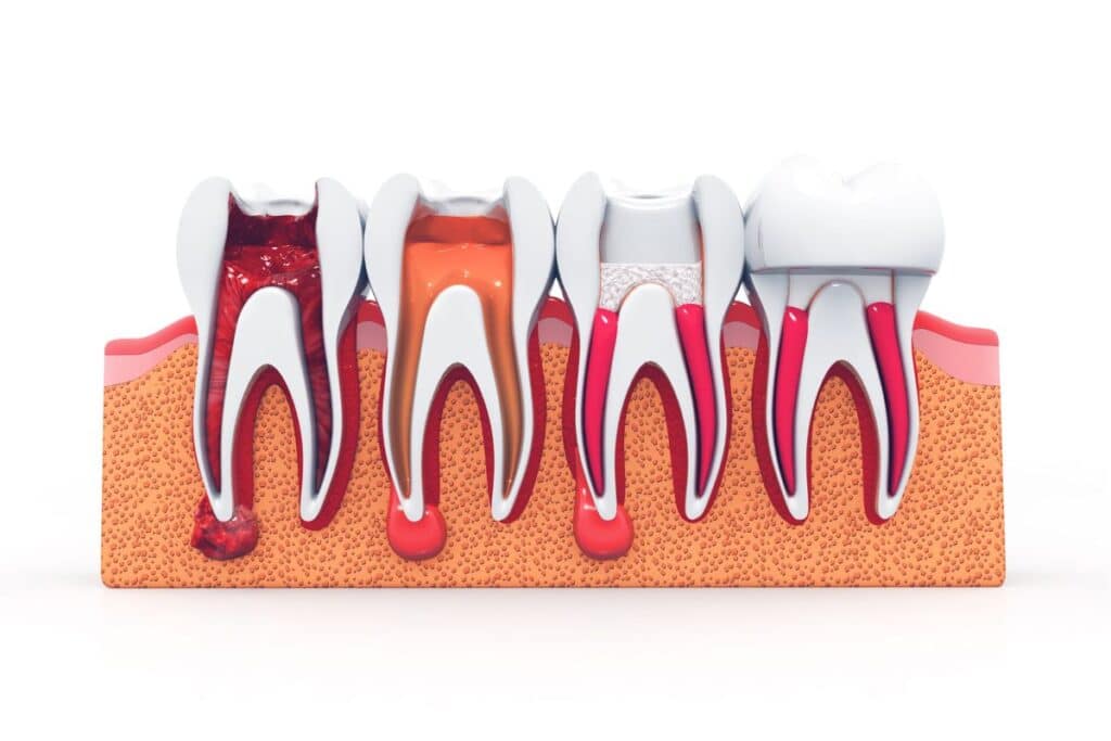 Root Canal Treatment in Round rock TX