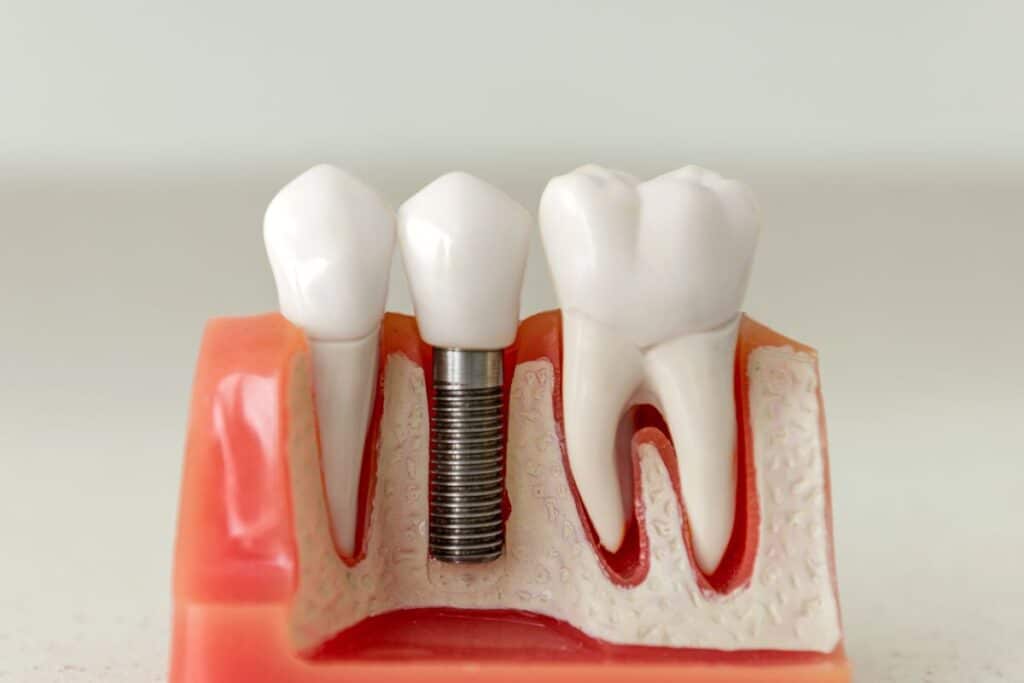 Dental Implants in Round Rock, TX