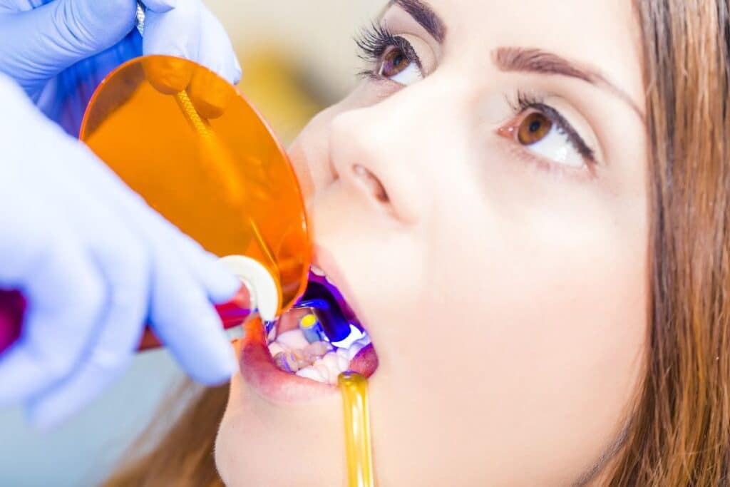 Dental Bonding in Round Rock