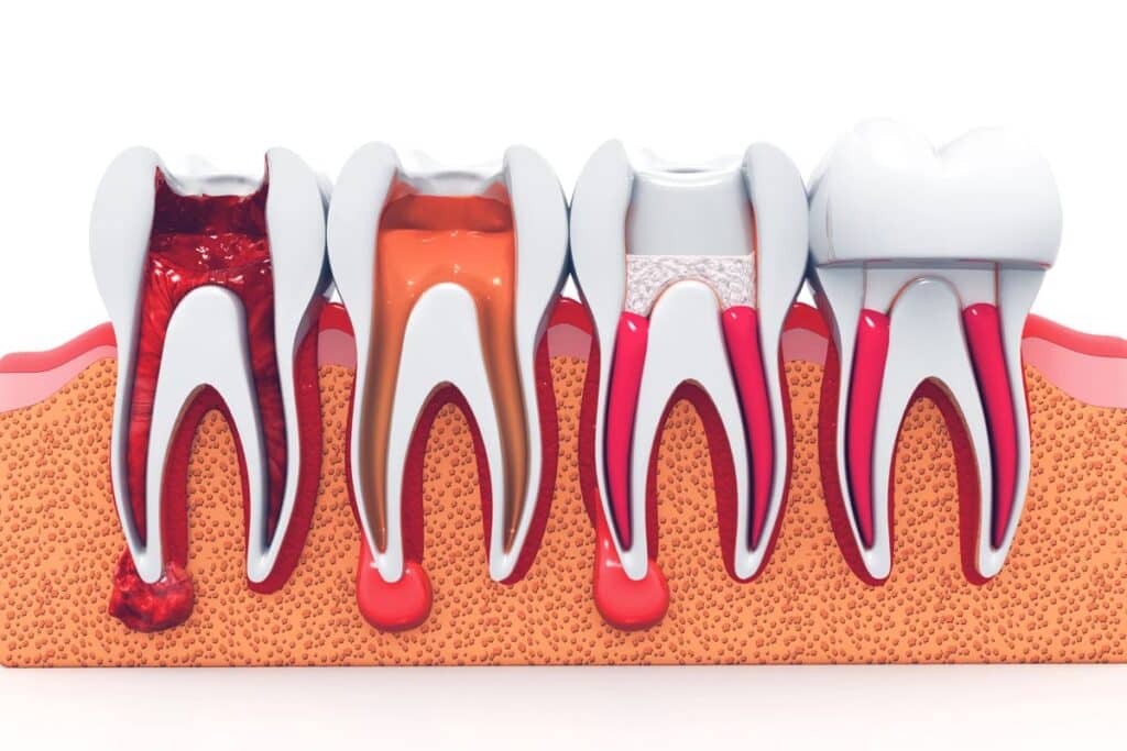 Root Canal Therapy in Round Rock