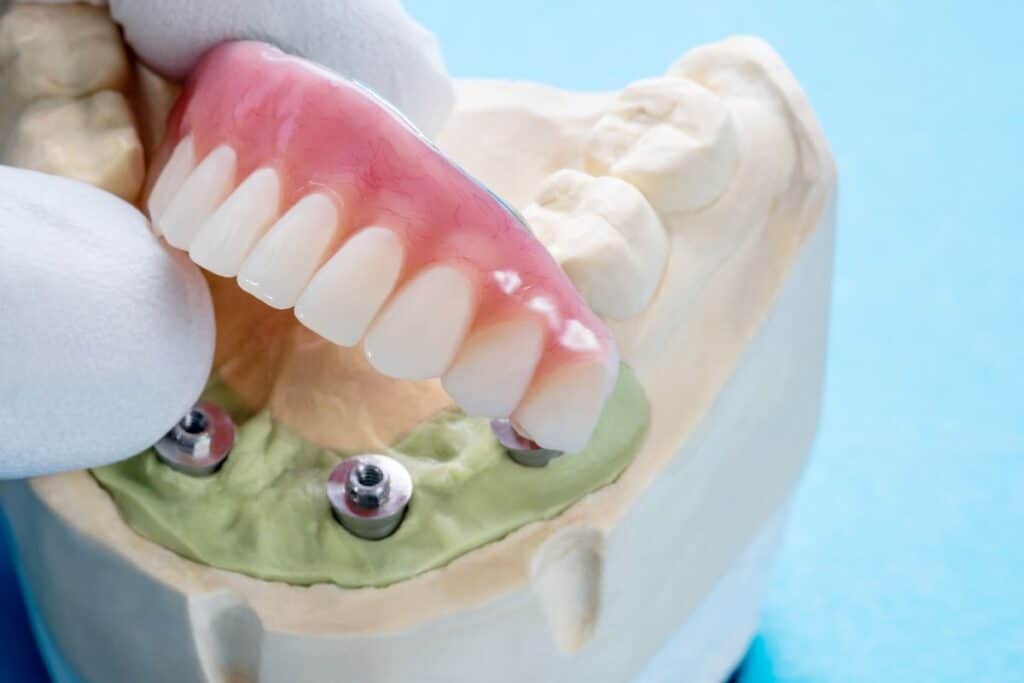 Dental Implants in Round Rock