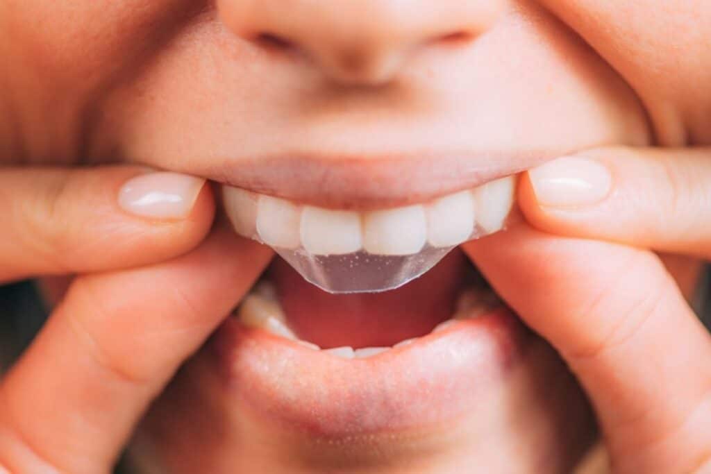 Teeth whitening in Round Rock