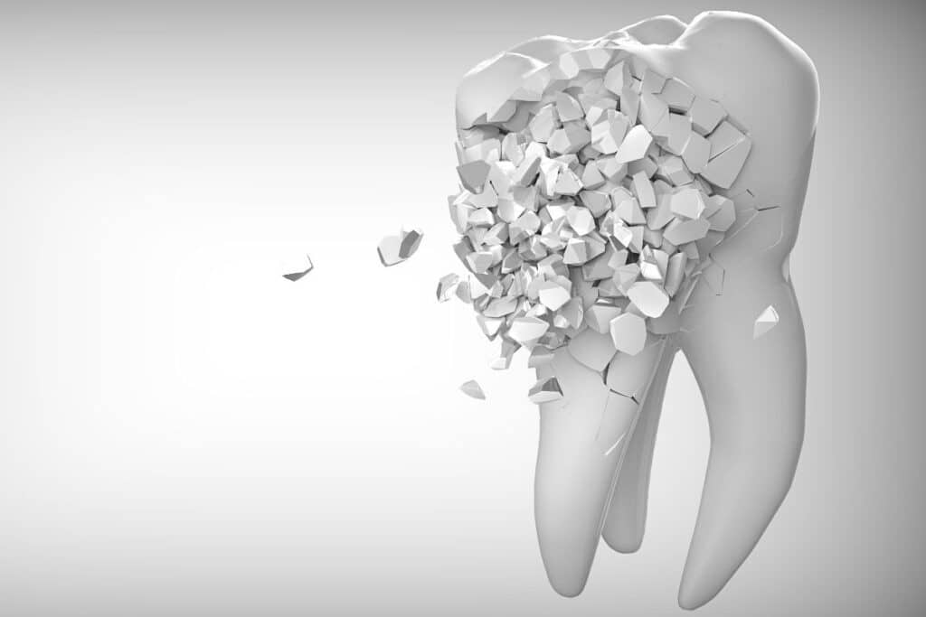 Tooth Decay in Children