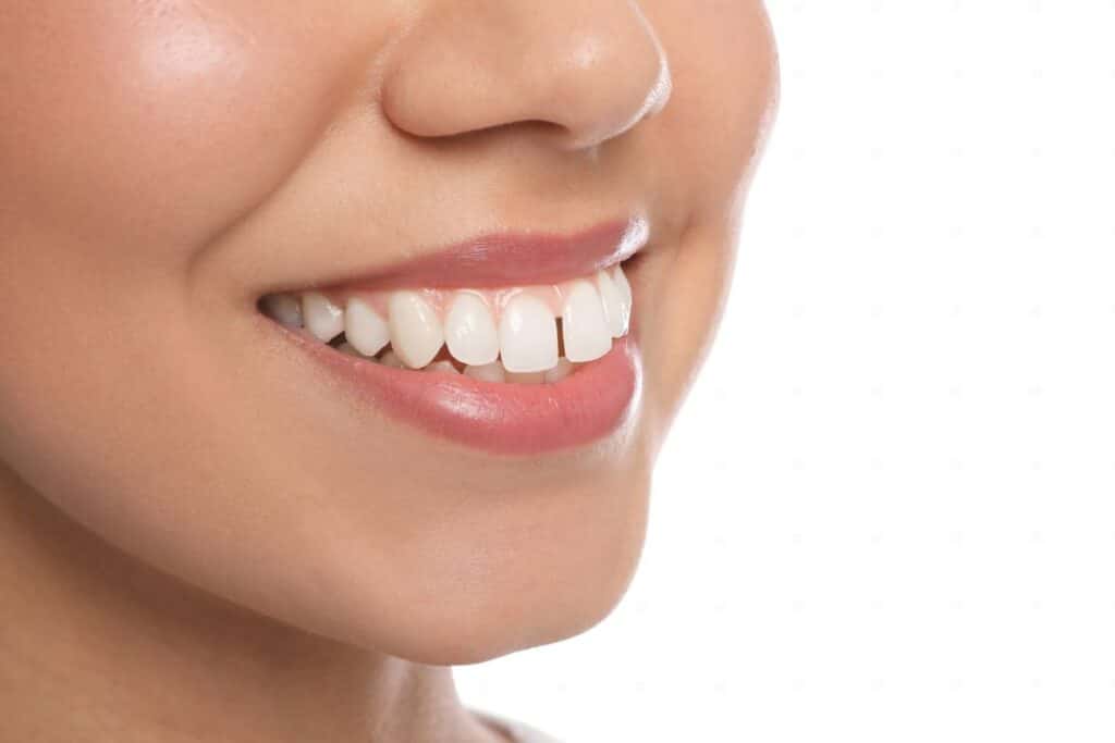 Are Gaps Between Teeth Normal
