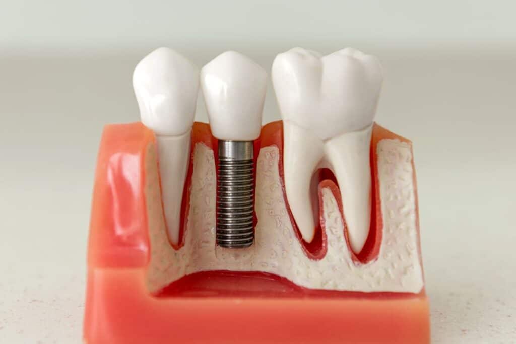 Eating After Dental Implant