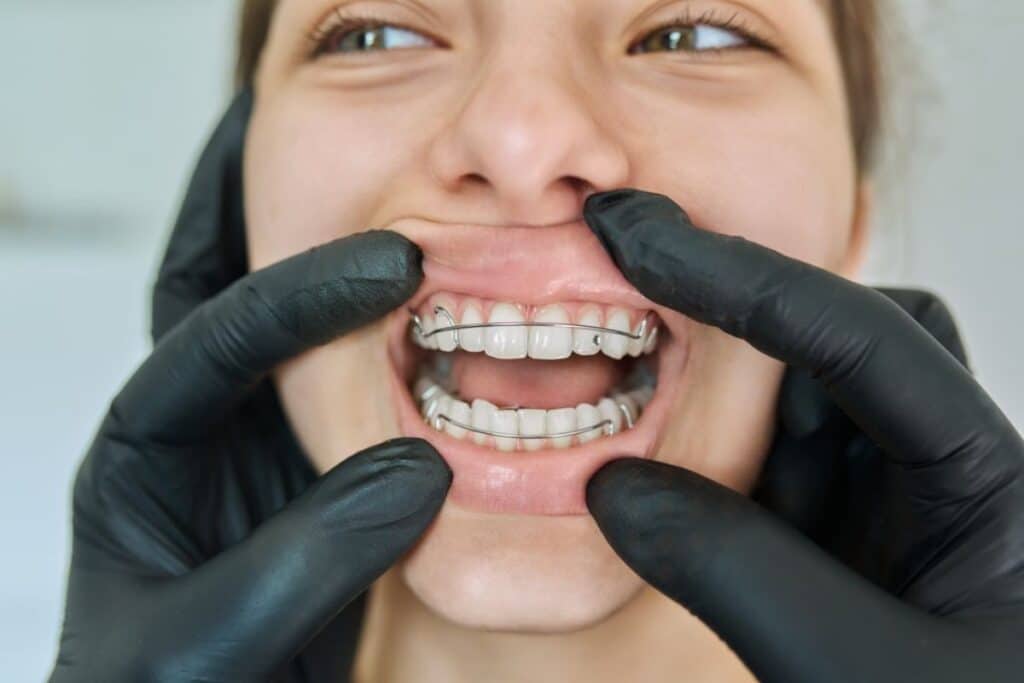 Can Cosmetic Dentistry Fix an Overbite