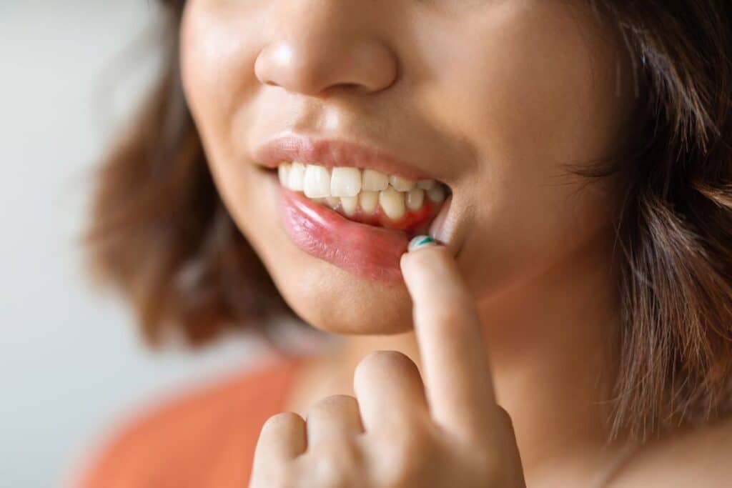 Inflammation of the Gums