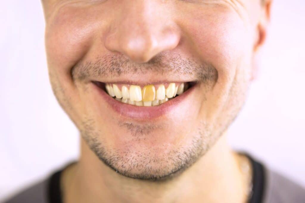 Why Are My Teeth Yellow Even Though I Brush Every Day
