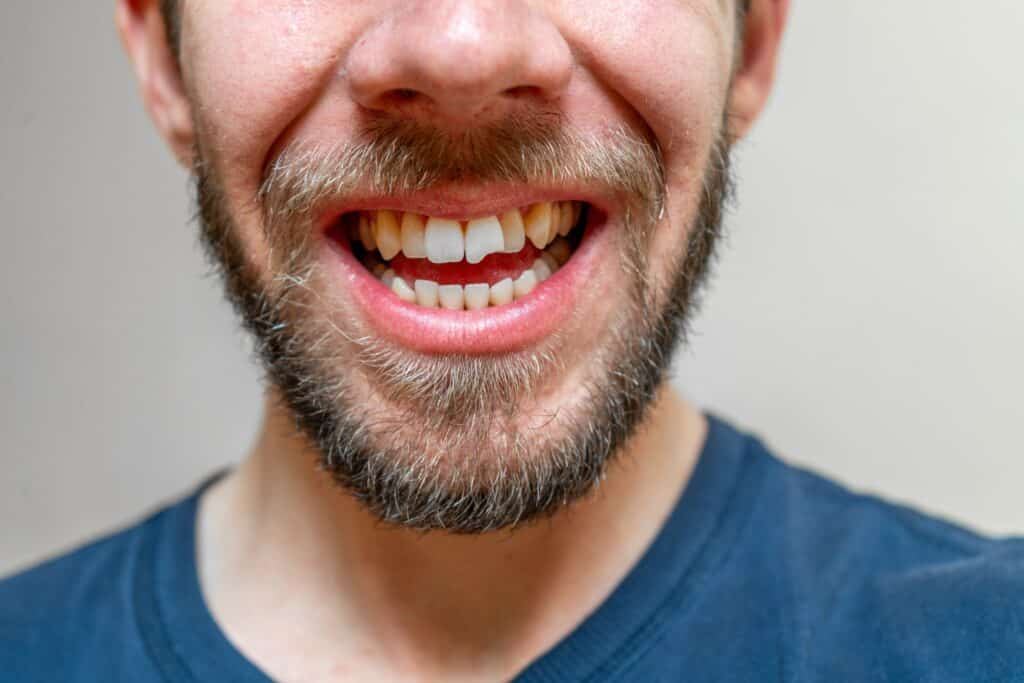 closeup of man in blue shirt with a chipped tooth