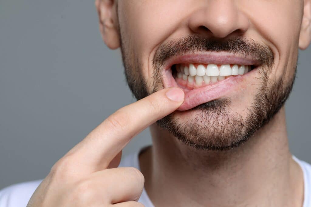 closeup of a man pulling down his lip exposing his gums